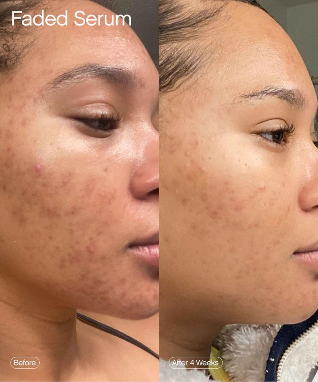 Faded Brightening and Clearing Serum | Reduces Discoloration, Post-Blemish Marks, Scars and Spots | Contains Kojic Acid and Niacinamide | Dermatologist-Tested, Vegan, Cruelty-Free (1.7 Fl Oz)